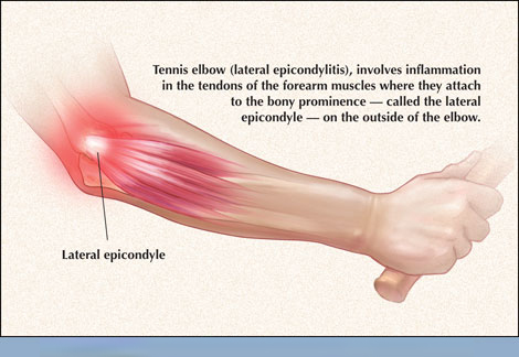 Tennis Elbow Tennis Elbow